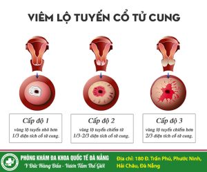 Bệnh viêm lộ tuyến cổ tử cung