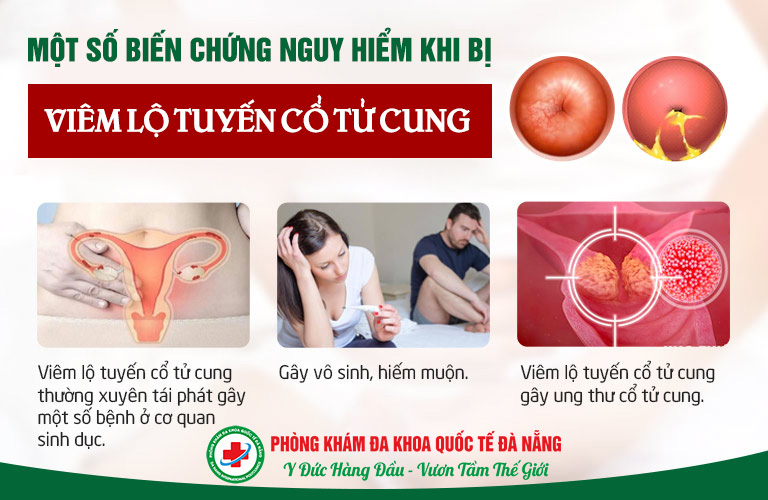 Biến chứng nguy hiểm của bệnh viêm lộ tuyến cổ tử cung