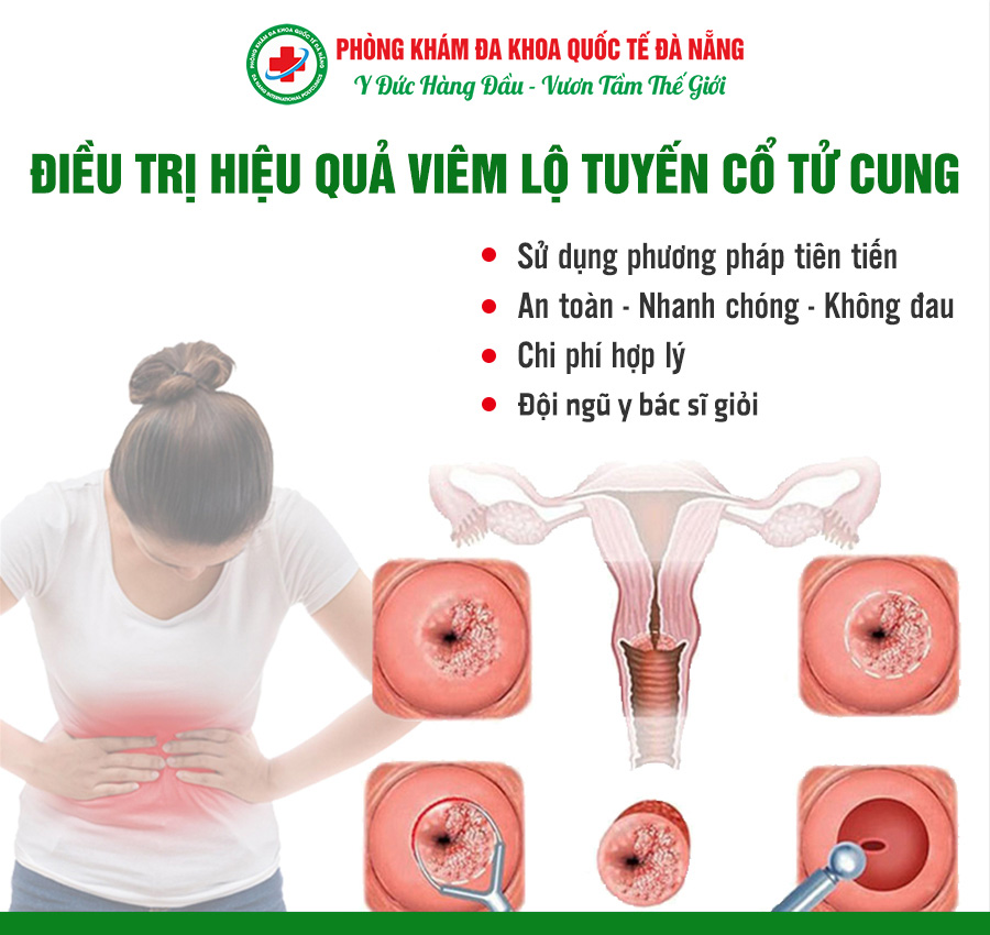Điều trị hiệu quả viêm lộ tuyến cổ tử cung