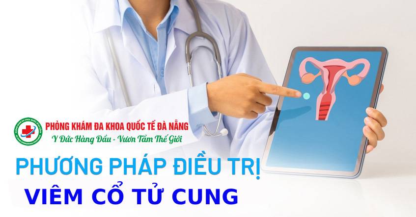 Phương pháp điều trị viêm cổ tử cung (1)