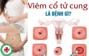 Viêm cổ tử cung là bệnh gì