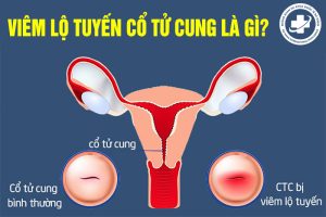 Viêm lộ tuyến cổ tử cung