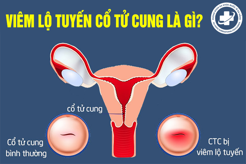 Viêm lộ tuyến cổ tử cung